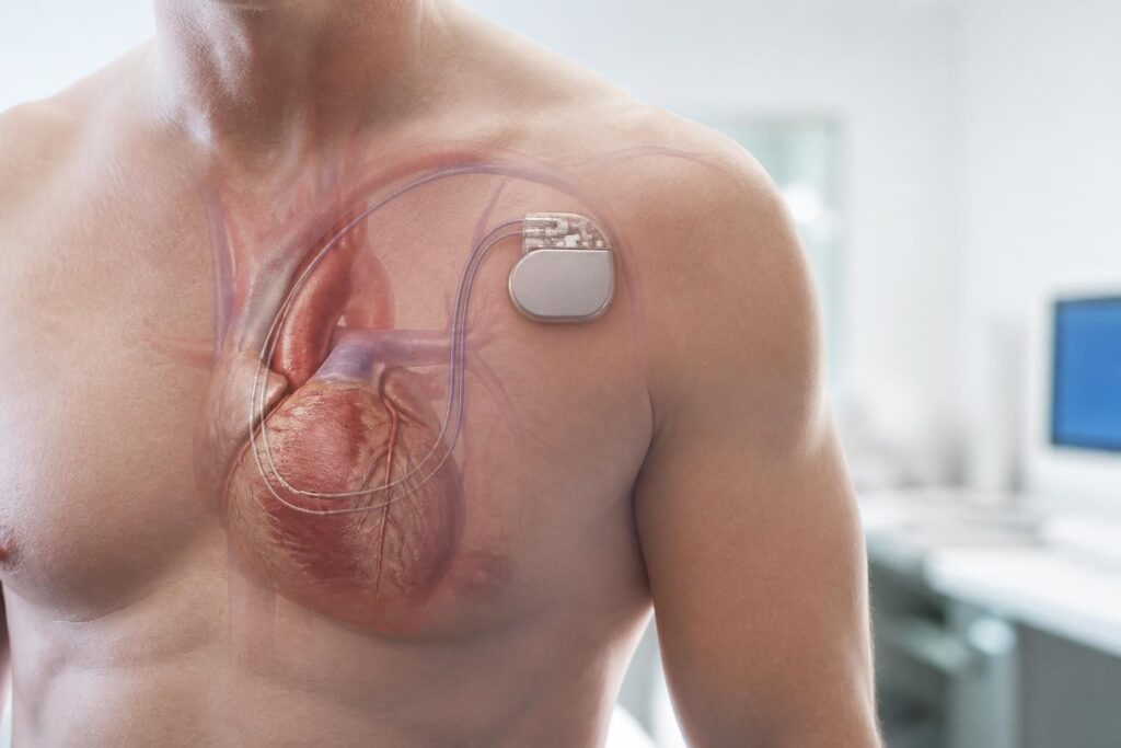 découvrez si un pacemaker empêche les crises cardiaques et ce que la science révèle sur le sujet pour mieux comprendre les risques et les protections offertes.
